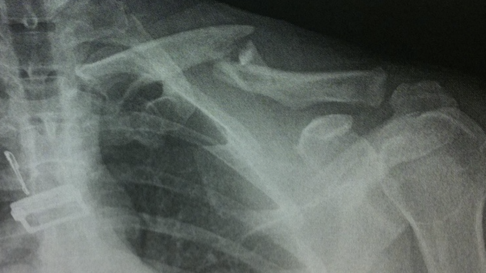 X-Ray of Broken Collarbone