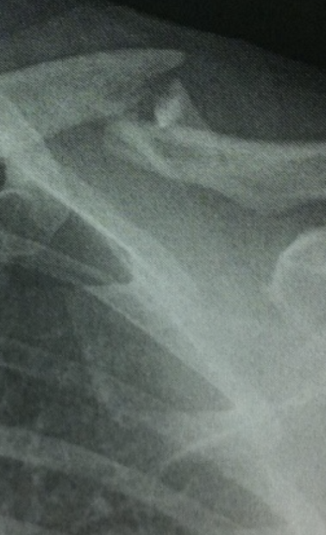 X-Ray of Broken Collarbone